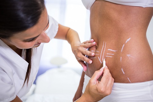 What is Liposuction? Turkey What is Liposuction? Turkey